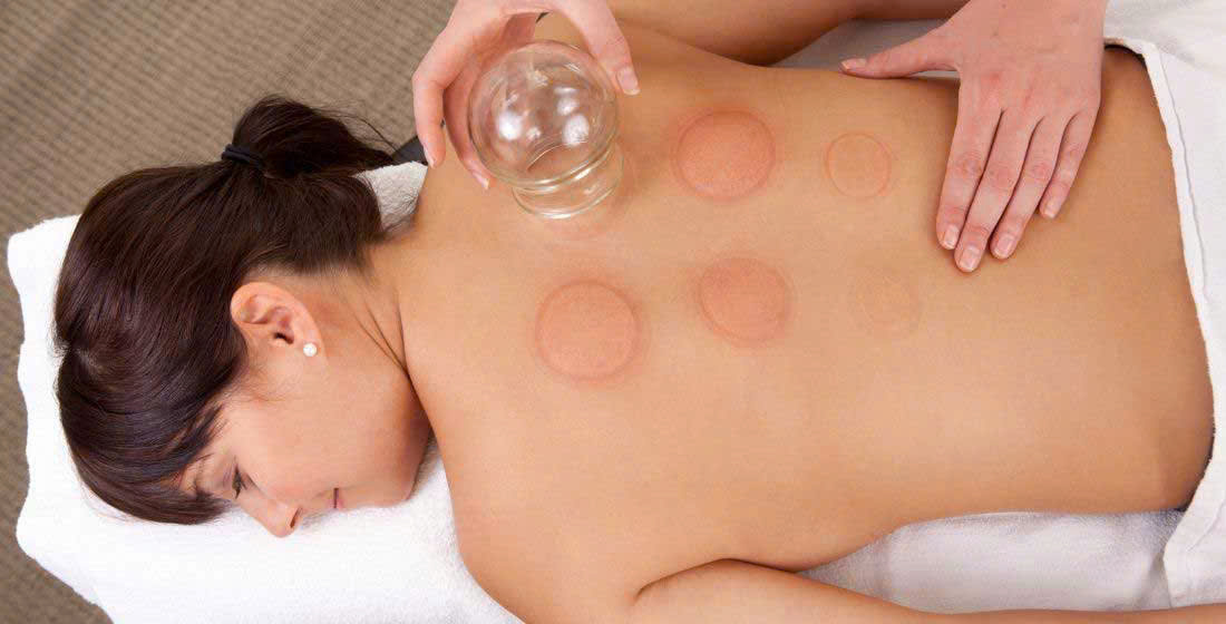 Cupping therapy Massage - Benefits, Types, and Who Can Try It