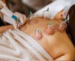 hijama cupping
