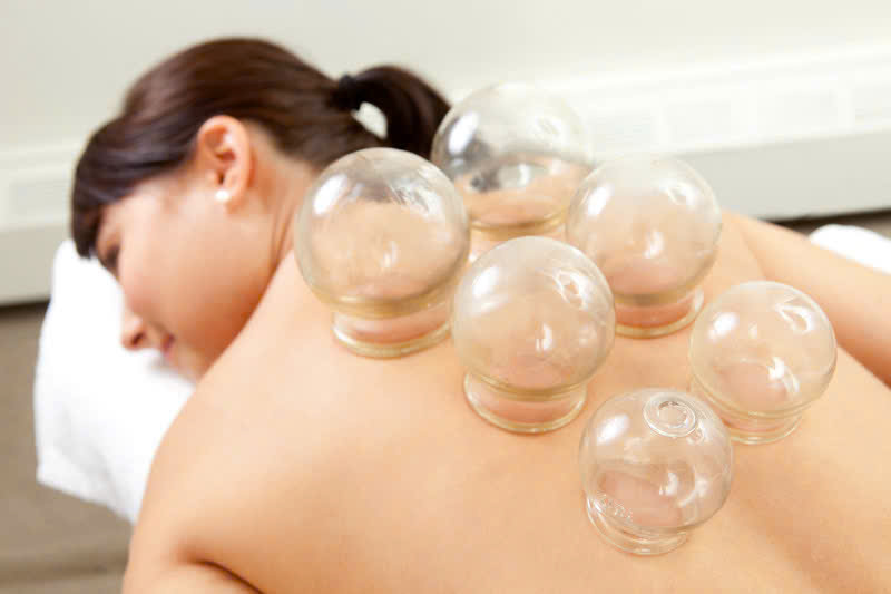 Cupping Therapy top 5 Benefits: Relieve Pain & Improve Circulation
